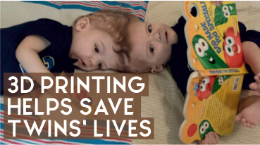 3D Printing Helps Save Twins' Lives
