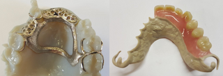 partial denture.png